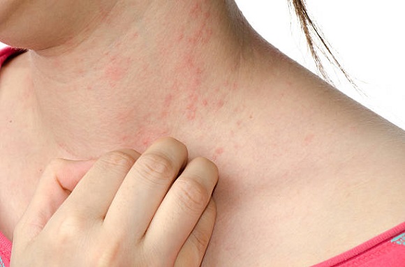 Alergi Dingin: Penyebab, Ciri-Ciri, Obat dan Cara Mencegahnya