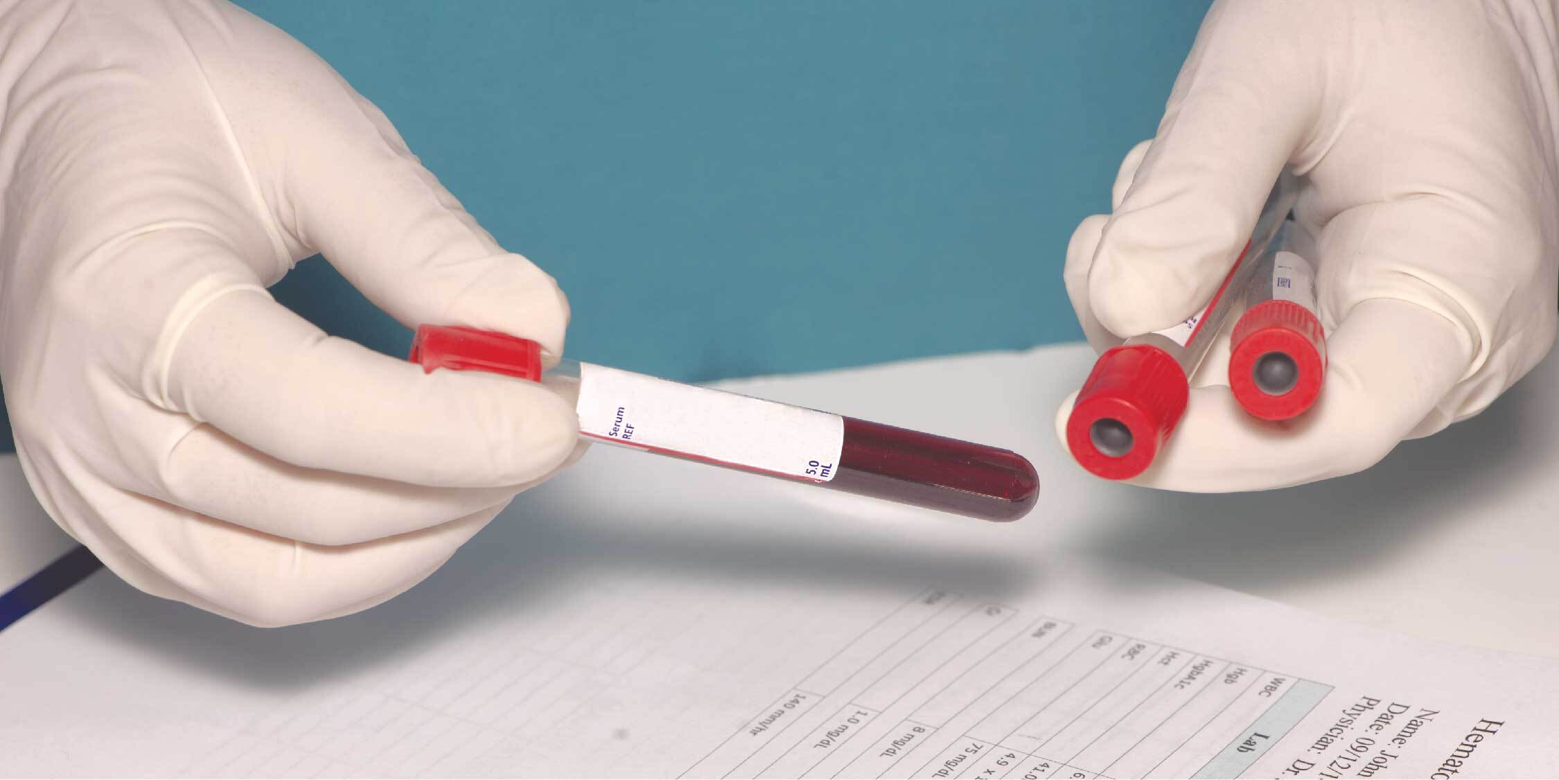 Кровь на вич спид гепатит. Тестирование крови. Взятие крови на ВИЧ гепатиты. Исследование крови на ВИЧ картинками.