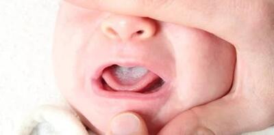 Cara Mengatasi Lidah Bayi Putih karena Sisa Susu